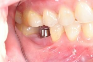 Dental Implant