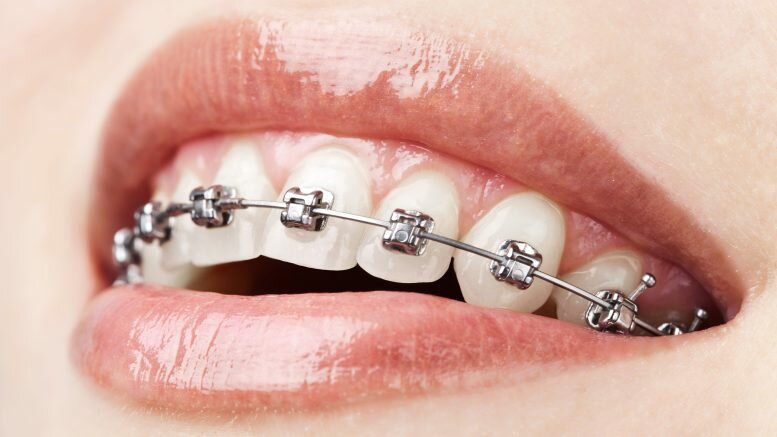 Closeup of smiling mouth with dental braces